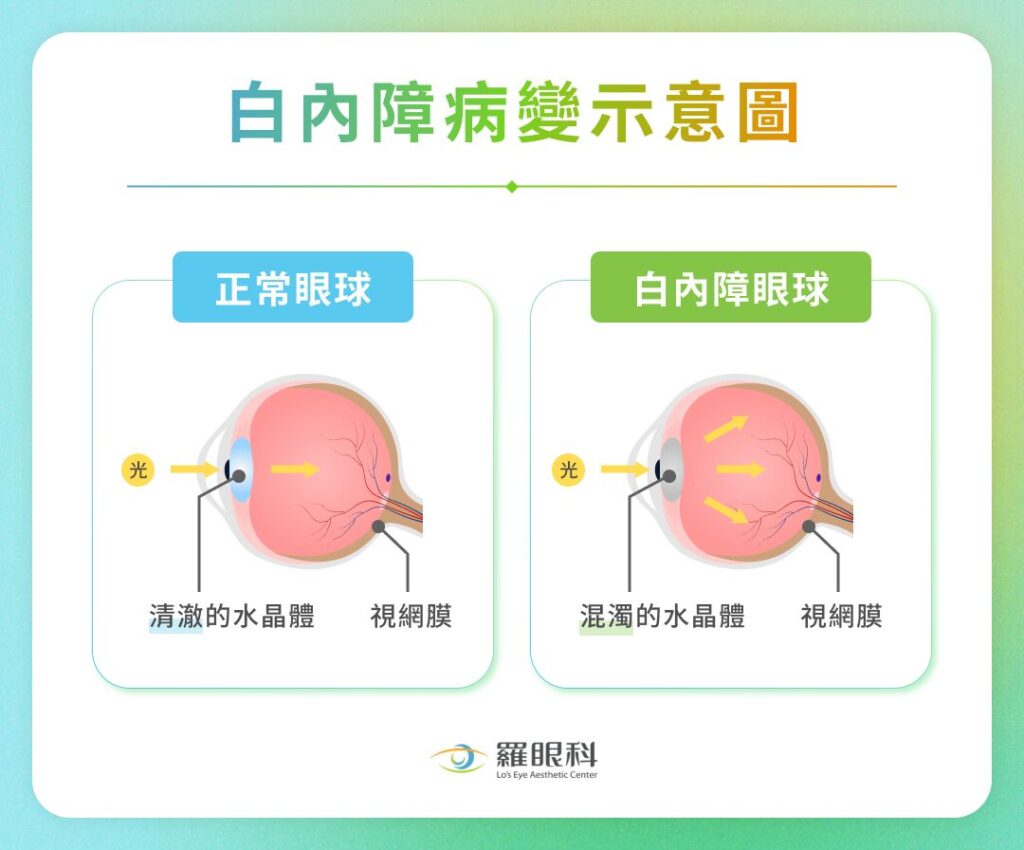 什麼是白內障?眼科醫師解析白內障症狀、成因、治療與預防方式! 1 白內障病變示意圖