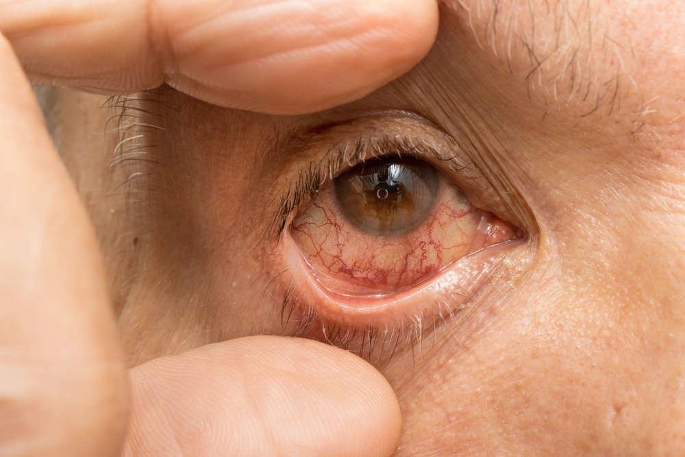a senior hispanic man with a pink eye infection in 2023 11 27 04 59 21 utc
