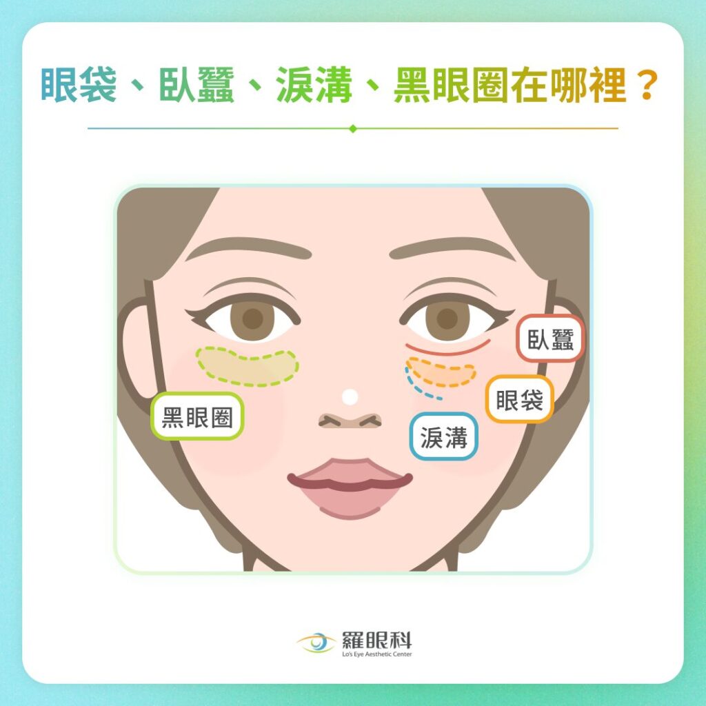 眼袋消除方式有哪些?一文掌握5大眼袋成因、3種眼袋消除方法 2 眼袋、臥蠶、淚溝、黑眼圈在哪裡?