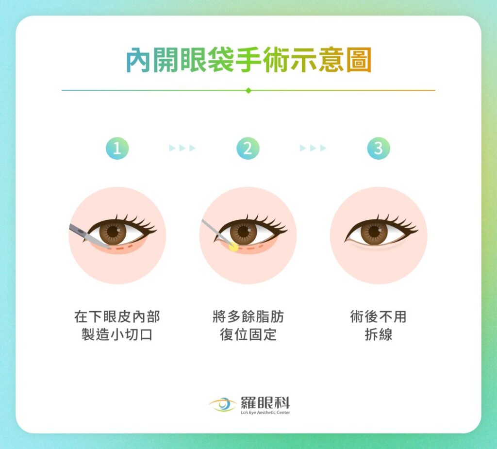 眼袋內開手術