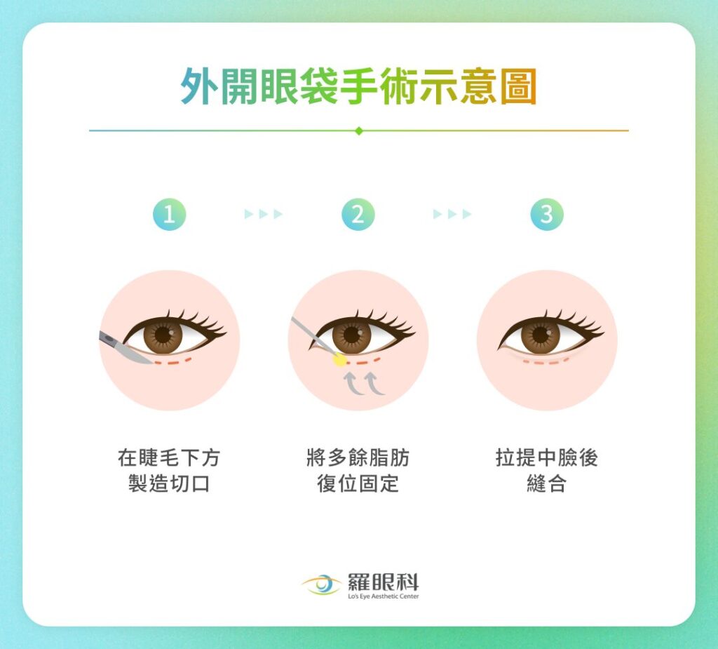 眼袋外開手術